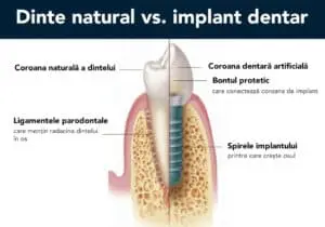 Diferența dintre un dinte natural si un implant