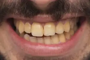 dinți îngălbeniți din cauza clorhexidinei