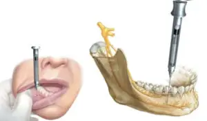 Cum se face anestezia dentara