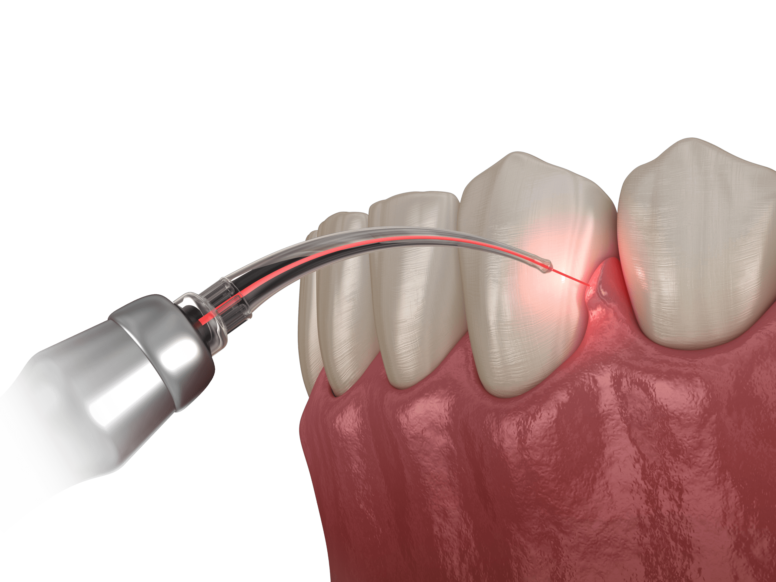 wallet acute experimental Laserul dentar | Tratamente cu laser stomatologic - Omnia Dental