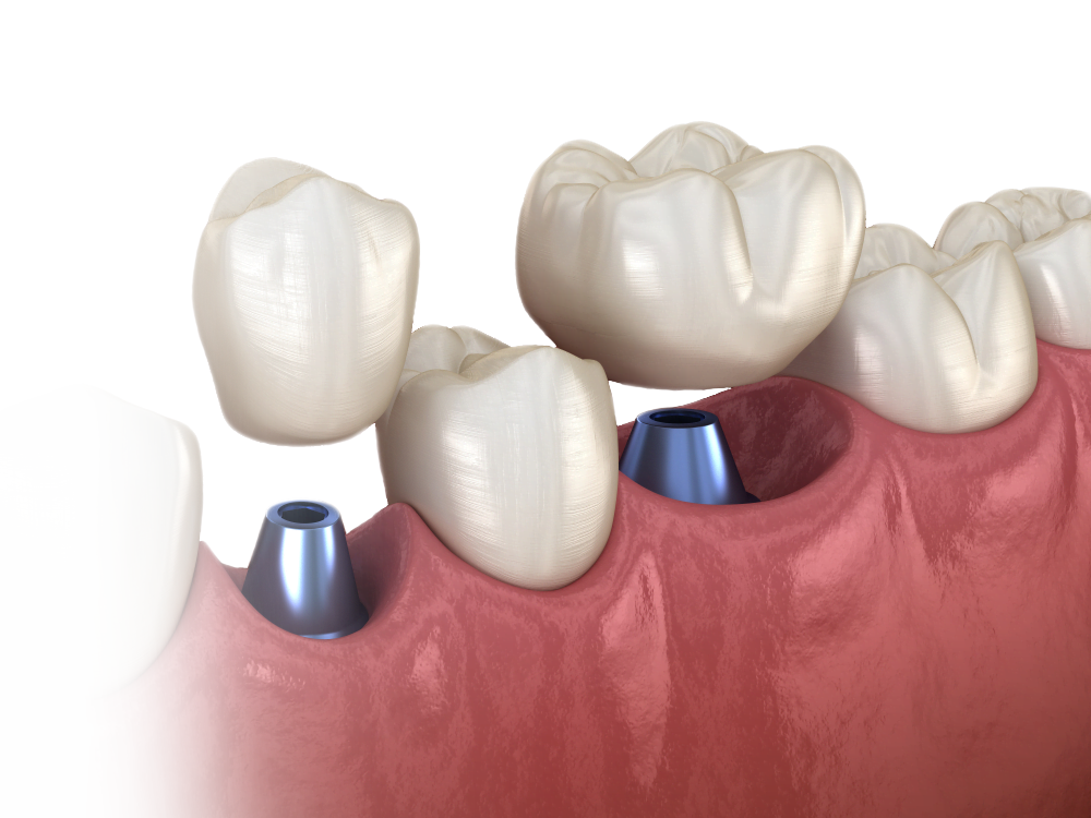 dentare pe Omnia Dental - Clinică stomatologică București
