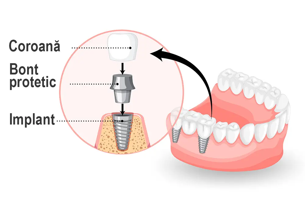 Bontul protetic pentru implantul dentar