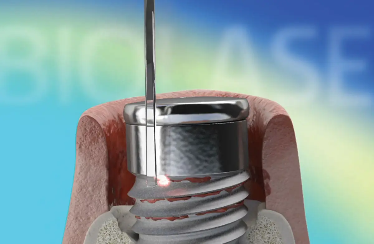 Tratament laser al periimplantitei cu Biolase Waterlase